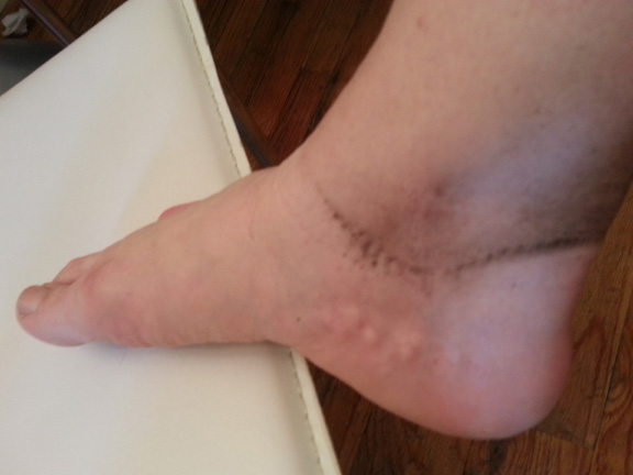 How dirty is walking around NYC? That's my sock line you're looking at (on the non-blistered-but-still-injured foot)!